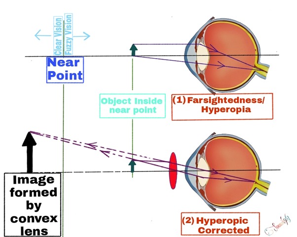 Hyperopia optics