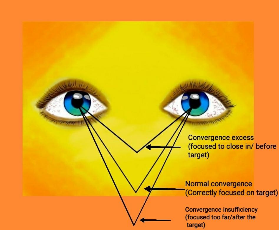 Asthenopic Eyes