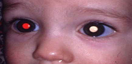 Retinoblastoma eye