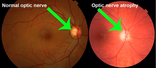 Optic Atrophy Optography