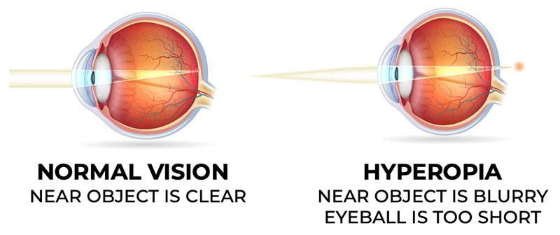 high-hyperopia-optography