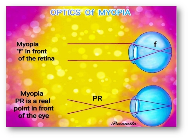 OPTICS OF MYOPIA
