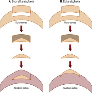 Refractive surgery