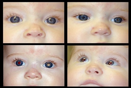 Child Retinoblastoma