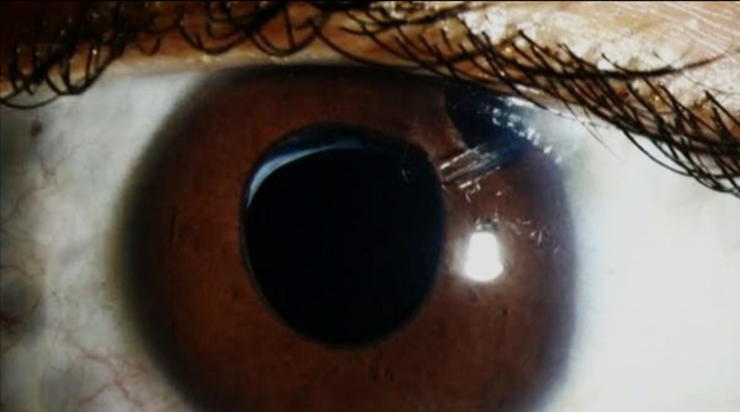 Aphakic eye