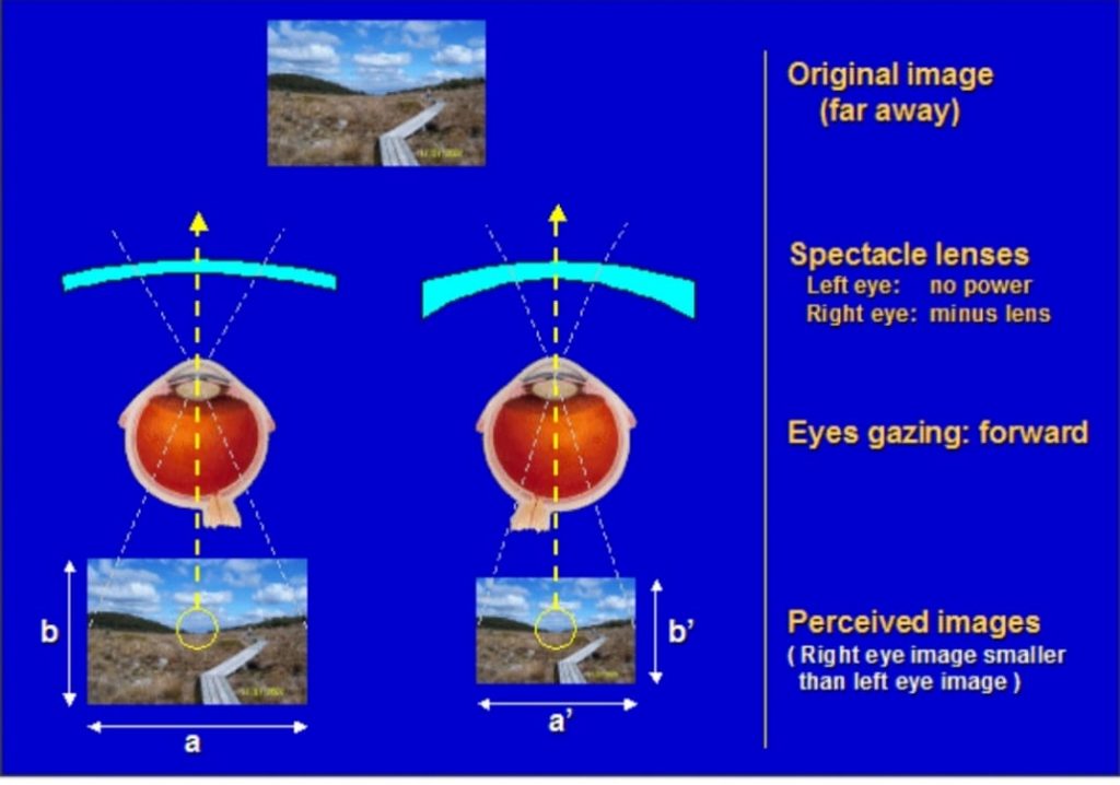 Diplopia (Double Vision) Physiological and pathological - Optography