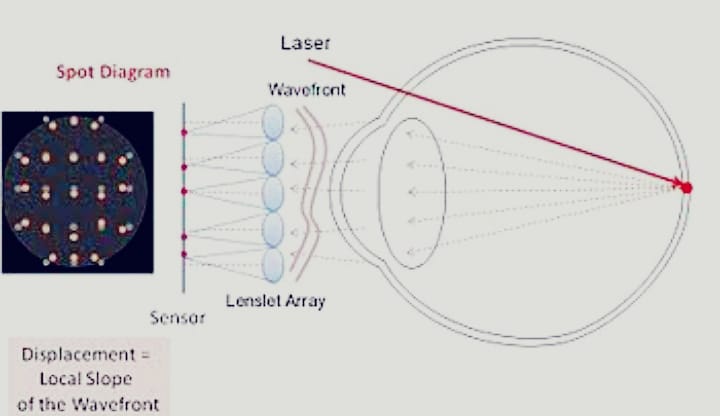 OPTICAL ABERRATIONS OF THE NORMAL EYE