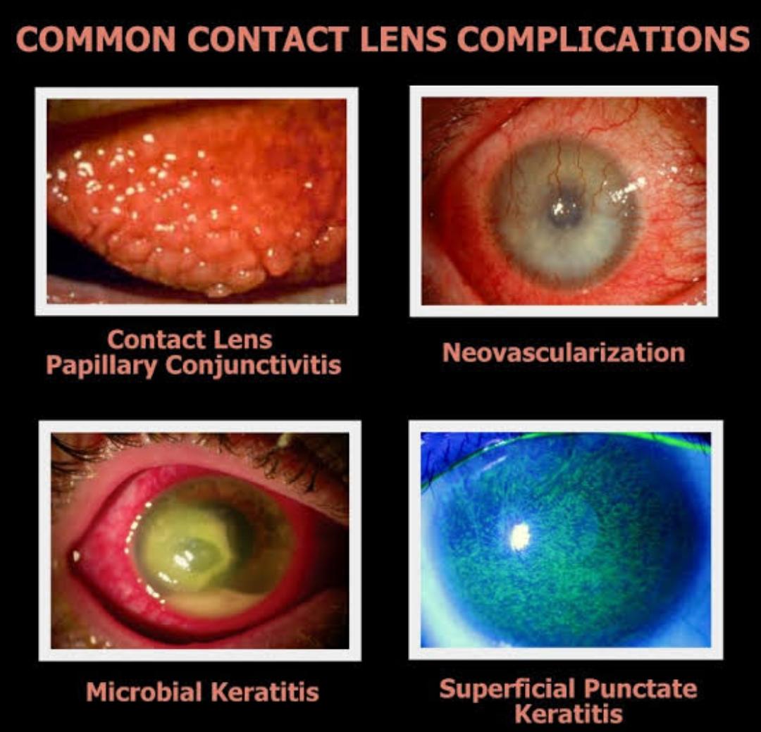 You are currently viewing Complications of contact lens wear