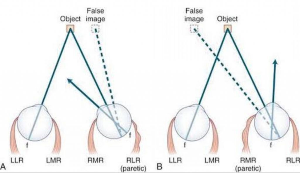 Diplopia store horizontal binocular