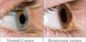 Read more about the article Contact  lens  fitting in keratoconus