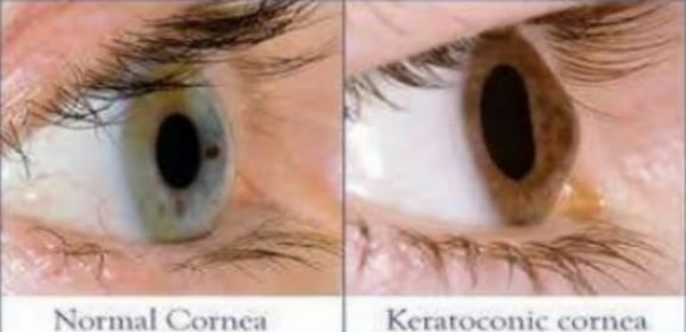 You are currently viewing Contact  lens  fitting in keratoconus