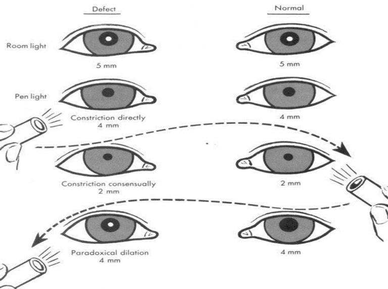 pupillary-reflexes-and-their-abnormalities-optography