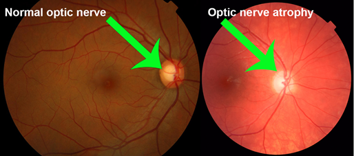 You are currently viewing Optic Atrophy