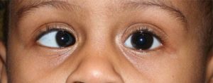 Read more about the article EVALUATION OF A CASE OF CONCOMITANT  STRABISMUS