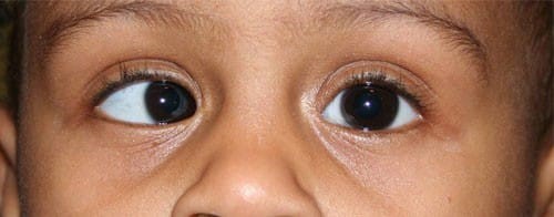EVALUATION OF A CASE OF CONCOMITANT  STRABISMUS