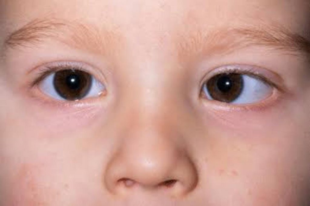 Diplopia (Double Vision) Physiological and pathological - Optography