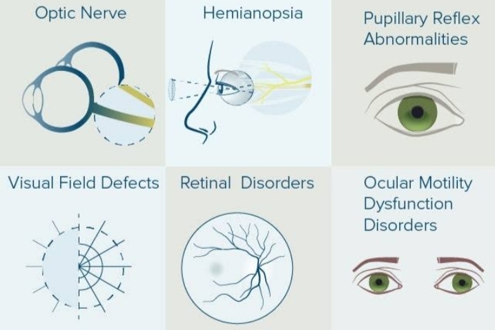 Ocular manifestation of diseases of central nervous system
