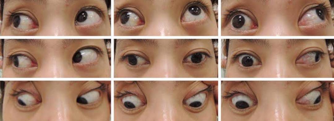 Difference between concomitant & paralytic strabismus