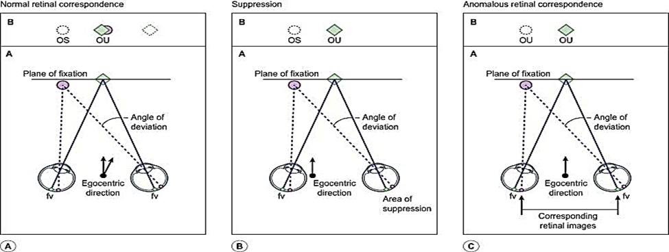 Read more about the article ARC (ABNORMAL RETINAL CORRESPONDENCE)