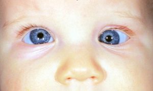 Read more about the article EVALUATION OF A CASE OF STRABISMUS
