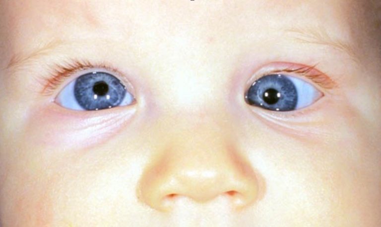 Diplopia (Double Vision) Physiological and pathological - Optography