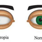 Divergent squint or Exotropia-378053487-1635164254802