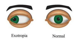 Read more about the article Divergent squint or Exotropia