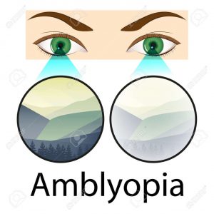 Read more about the article TREATMENT OF AMBLYOPIA