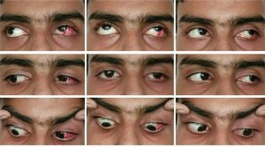Read more about the article CONSECUTIVE EXOTROPIA