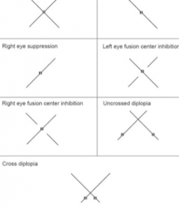SUPPRESSION IN STRABISMUS - Optography