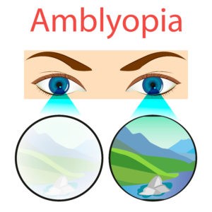 You are currently viewing CLASSIFICATION AND TERMOLOGY OF AMBLYOPIA
