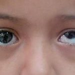 CLASSIFICATION OF VERTICAL STRABISMUS