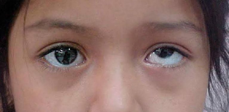 CLASSIFICATION OF VERTICAL STRABISMUS - Optography