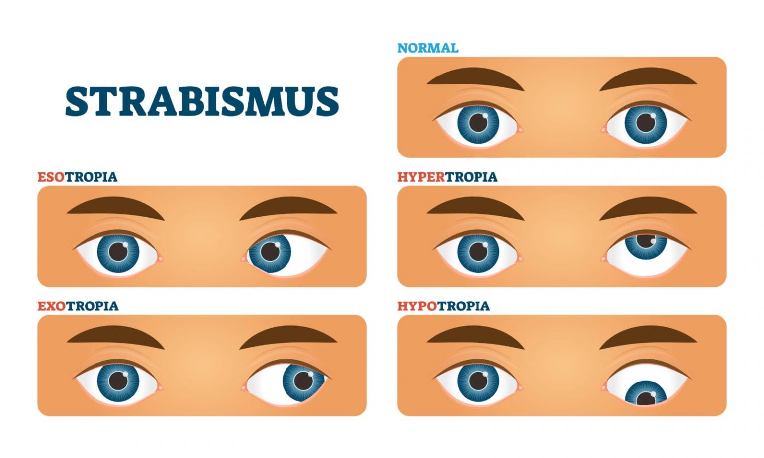 dynamic-retinoscopy-a-comprehensive-guide-optography