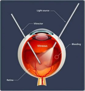 vitrectomy