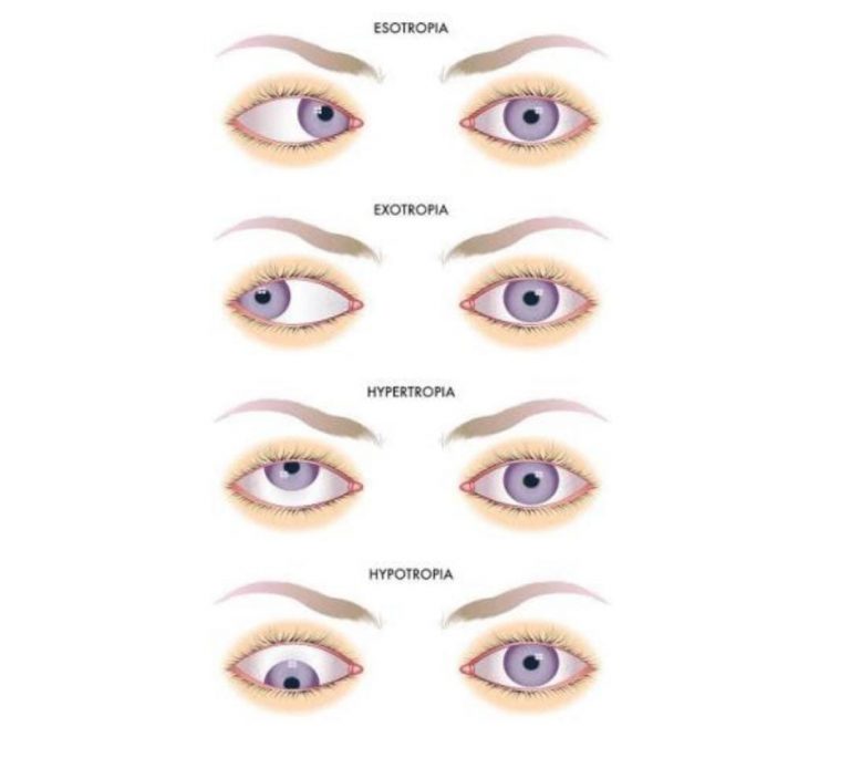 Classification of hetrotropia - Optography