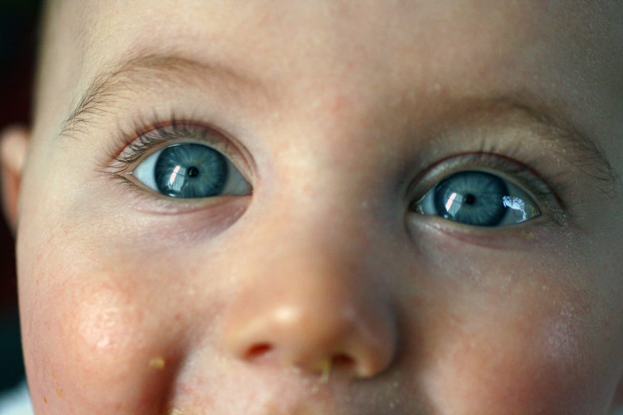 Read more about the article CHILDHOOD BLINDNESS