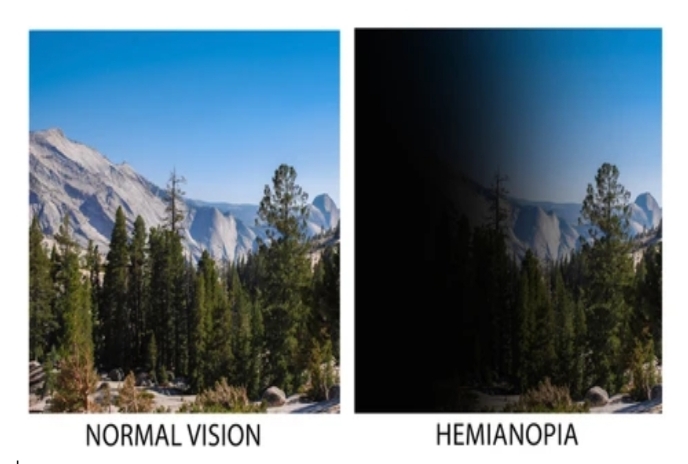 You are currently viewing Types of visual field defects in low vision cases.