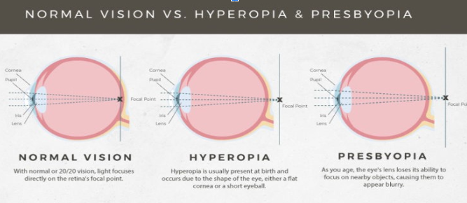 Read more about the article ADVANCES IN THE TREATMENT OF PRESBYOPIA