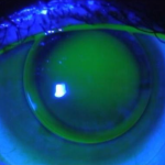 Importance of Keratometry in Contact Lens practice