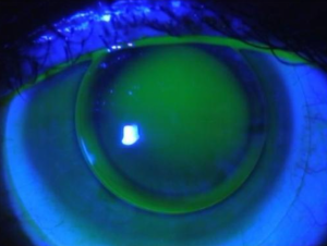 Read more about the article Importance of Keratometry in Contact Lens practice