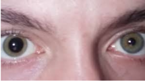 Read more about the article ANOMALIES OF PUPILLARY REFLEX