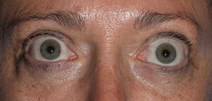 Read more about the article How Thyroid affects our eyes