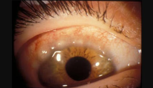 You are currently viewing Vernal Keratoconjuctivitis