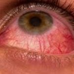 Know about Conjunctivitis & Its Management