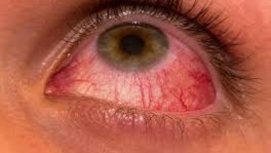 You are currently viewing Know about Conjunctivitis & Its Management