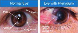 Read more about the article Describe about Pre operative & post operative compliance of pterygium surgery