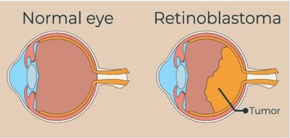 Read more about the article Describe about Retinoblastoma