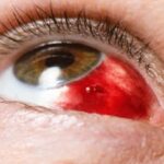 Types of Ocular Injuries