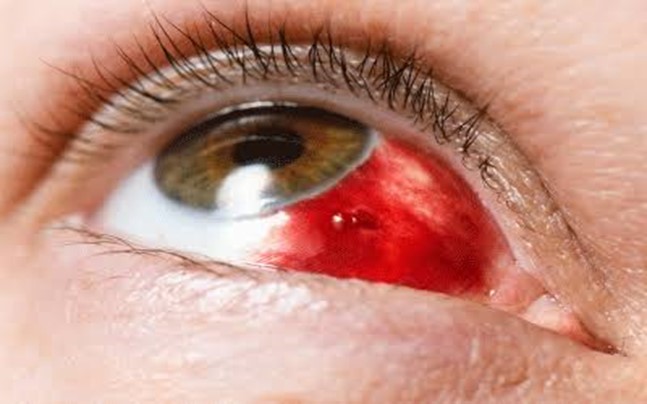 You are currently viewing Types of Ocular Injuries